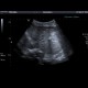 Liver metastasis, peritoneal carcinomatosis: US - Ultrasound